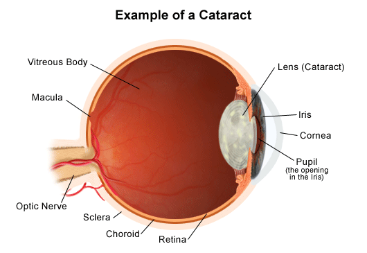 What is Cataract and How to treat it effectively? | Pittsburgh Eye Associate
