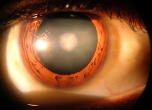 what is cataract ?